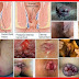 Obat Ambeyen Selain Ambeven Apakah Ada? thumbnail