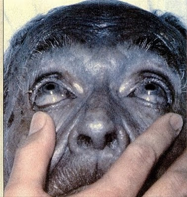 Plata Coloidal