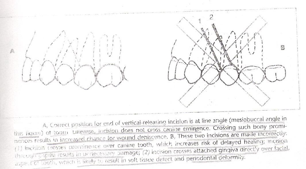 WizDent Principles Of Complicated ExodontiaSurgical/Open method of