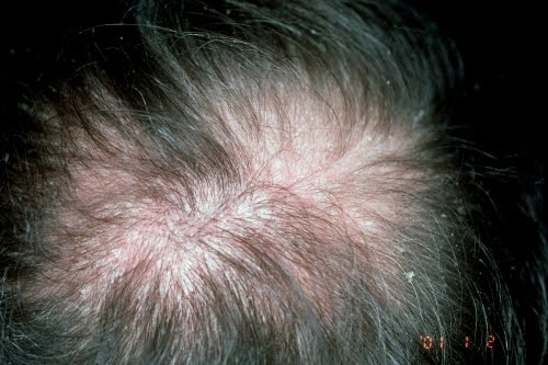 Red ginseng de la caída de los cabello
