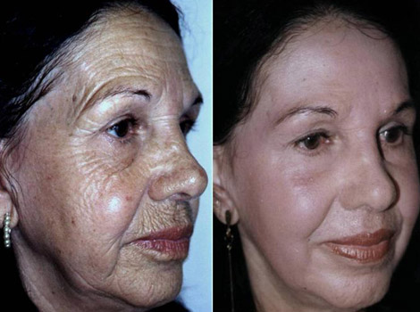 qual melhor peeling para manchas