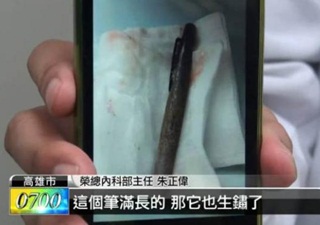 Sakit Perut Parah, Ternyata Pena Bersarang di Perut Wanita Ini Sakit Perut Parah, Ternyata Pena Bersarang di Perut Wanita Ini