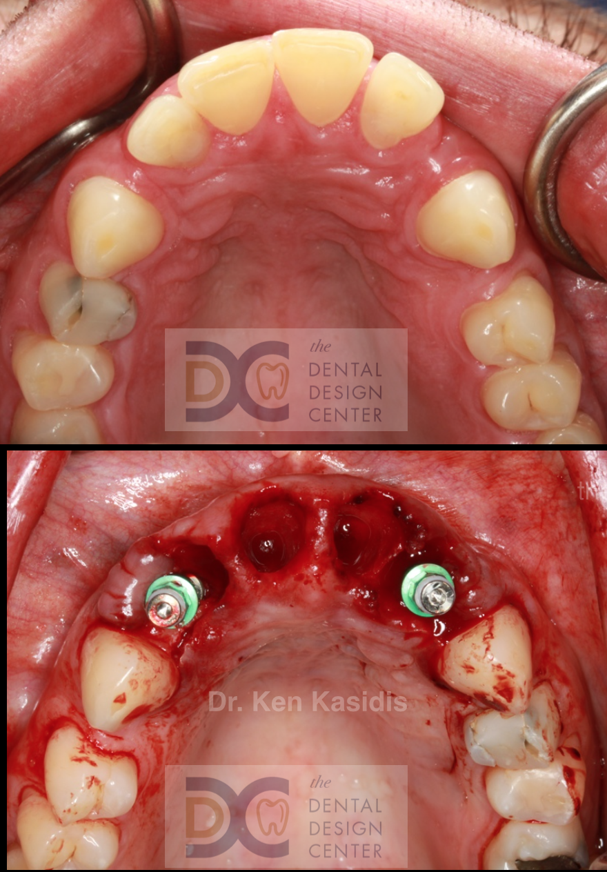 dental%2Bimplant%2Bimmediate%2Bplacement
