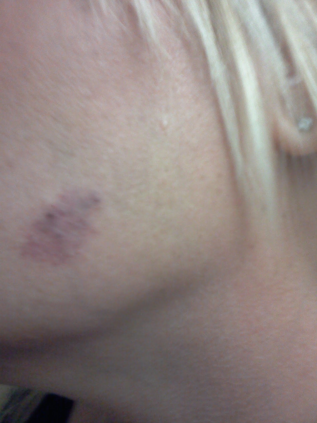 Life with Lupus Symptoms from mild to severe. These are