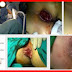 Obat Mujarab Atasi Berak Di Sertai Darah thumbnail