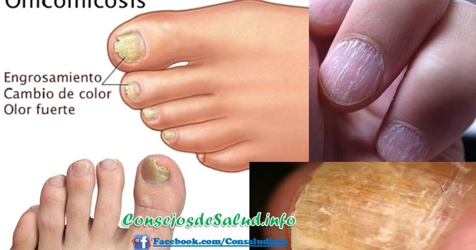 Que es posible sanar el hongo de las uñas de los pies