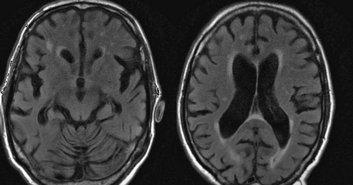 Dr Balaji Anvekar FRCR: Superficial Siderosis MRI