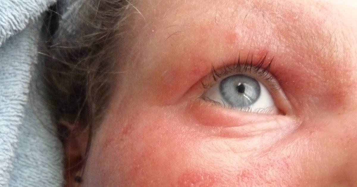 I Have Eczema The Great Ooze My Skin Is Crying