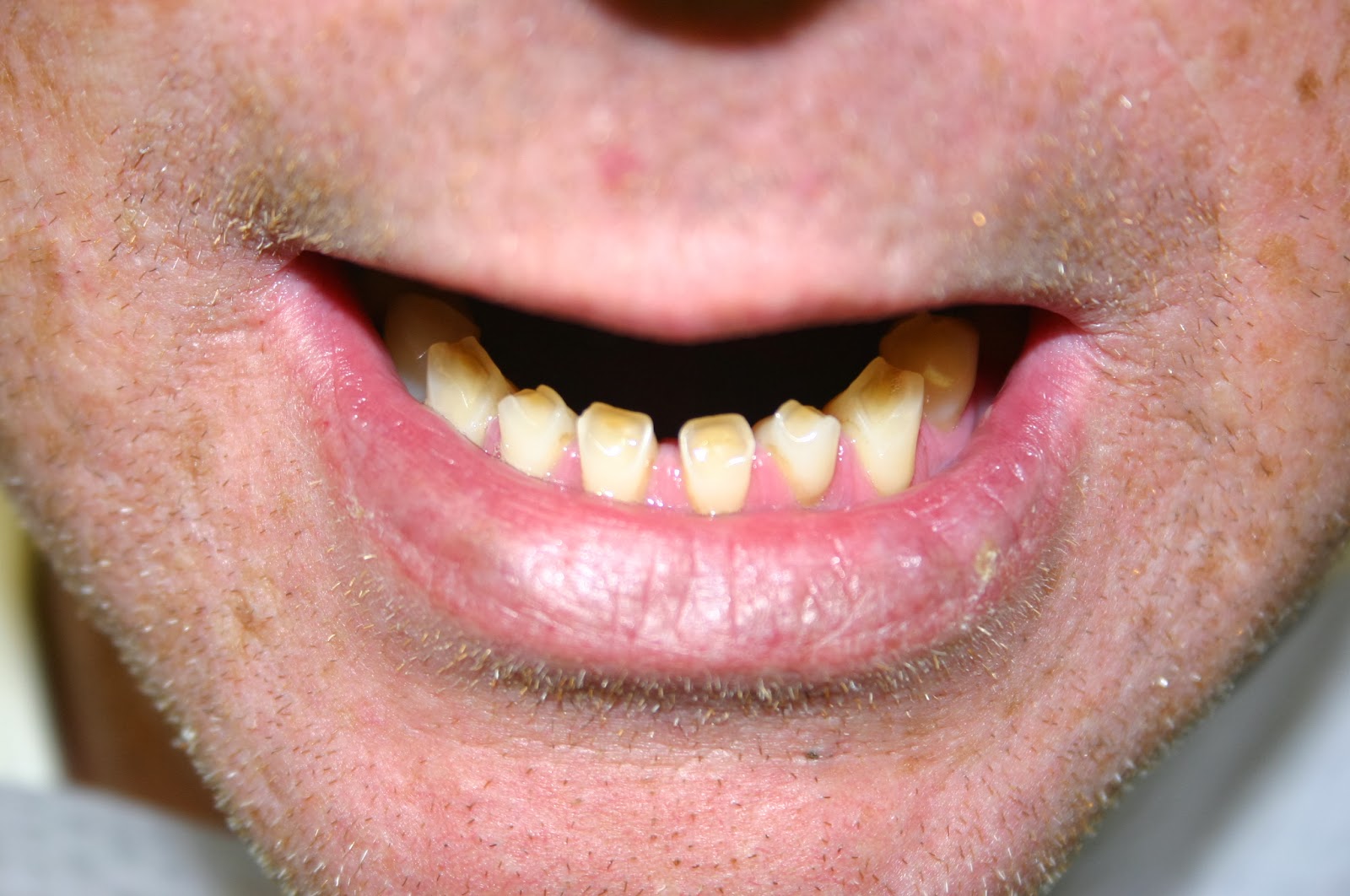 enamel tooth erosion dental severe wear acid structure crescent
