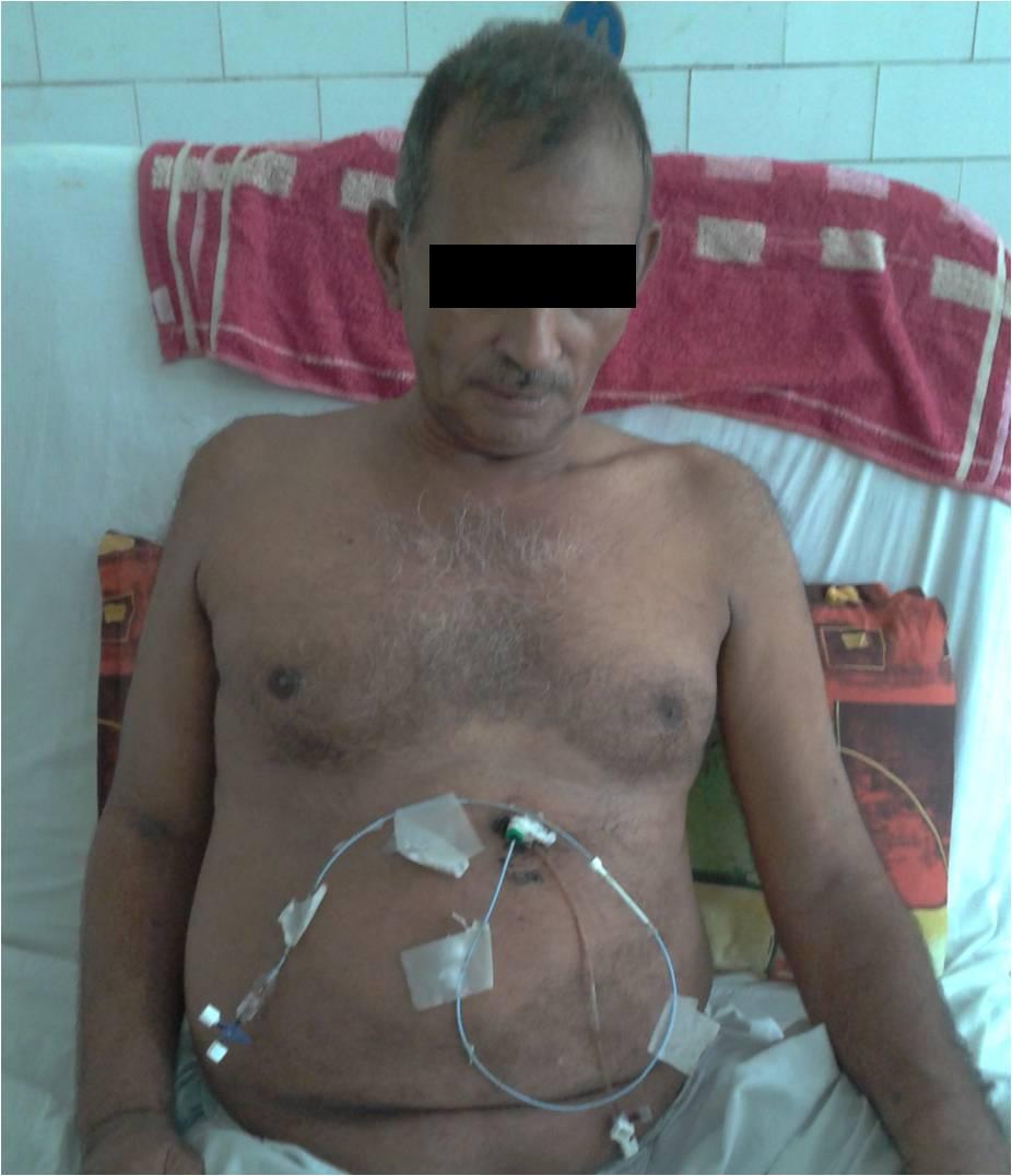 Massive Pericardial Effusion Case X Ray and CT Diagnosis And Treatment