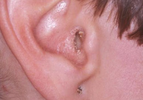 Como comer la psoriasis enferma