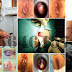 Obat Anus Bengkak Sakit Buat Duduk Ada Benjolan thumbnail