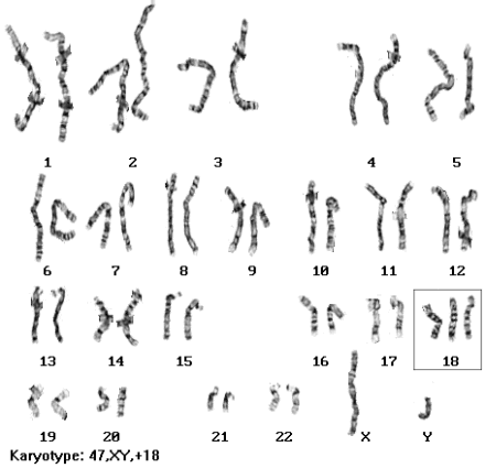 Trisomy Trisomy Diseases Conditions Medscape Reference