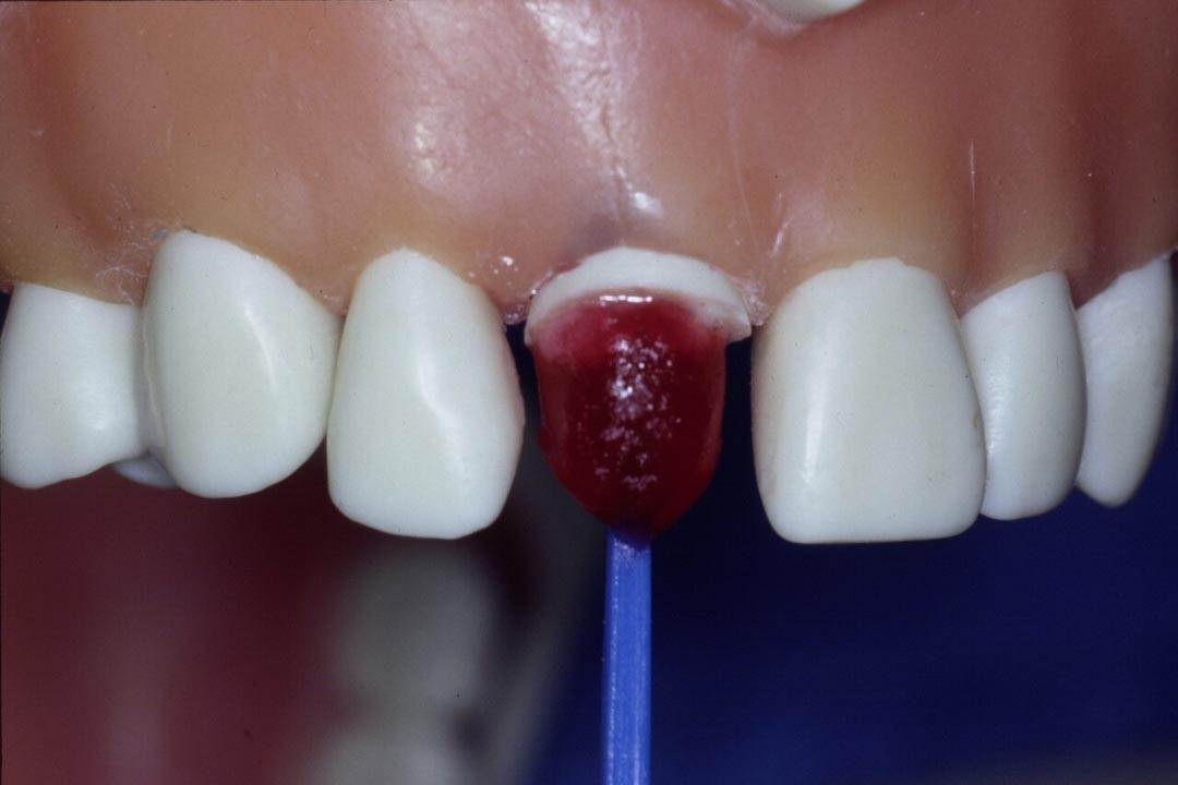 Dentistry Custom Cast Dowel Core