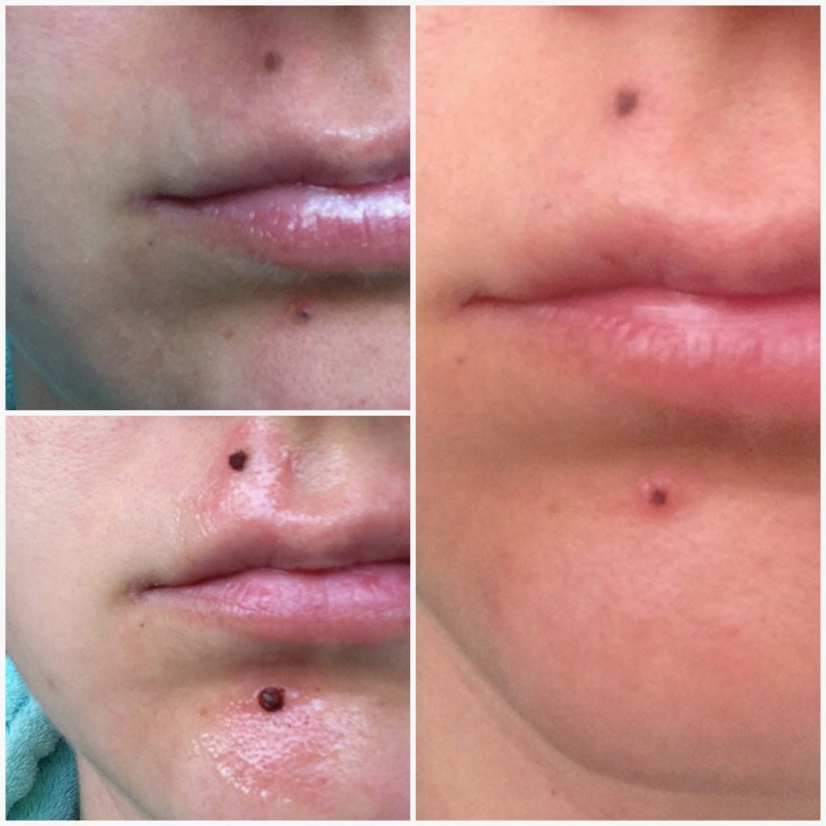 Charlotte in England How to remove moles at home