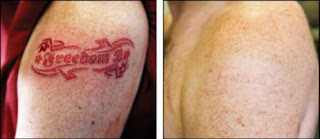 Retirar Tattos Como retirar tattos