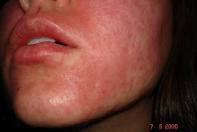 La psoriasis sobre las uñas al niño