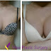 VIEW Plastic Surgery Korea - (Real Review) Breast Augmentation Before & After