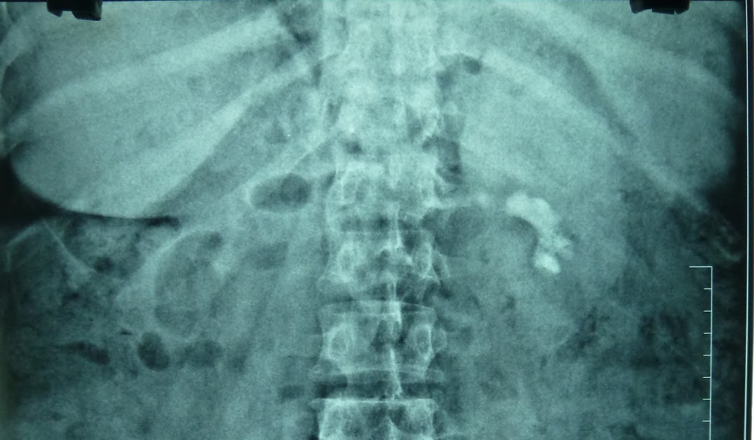 Ramayya Pramila Urology Hospital Partial staghorn kidney stone removed