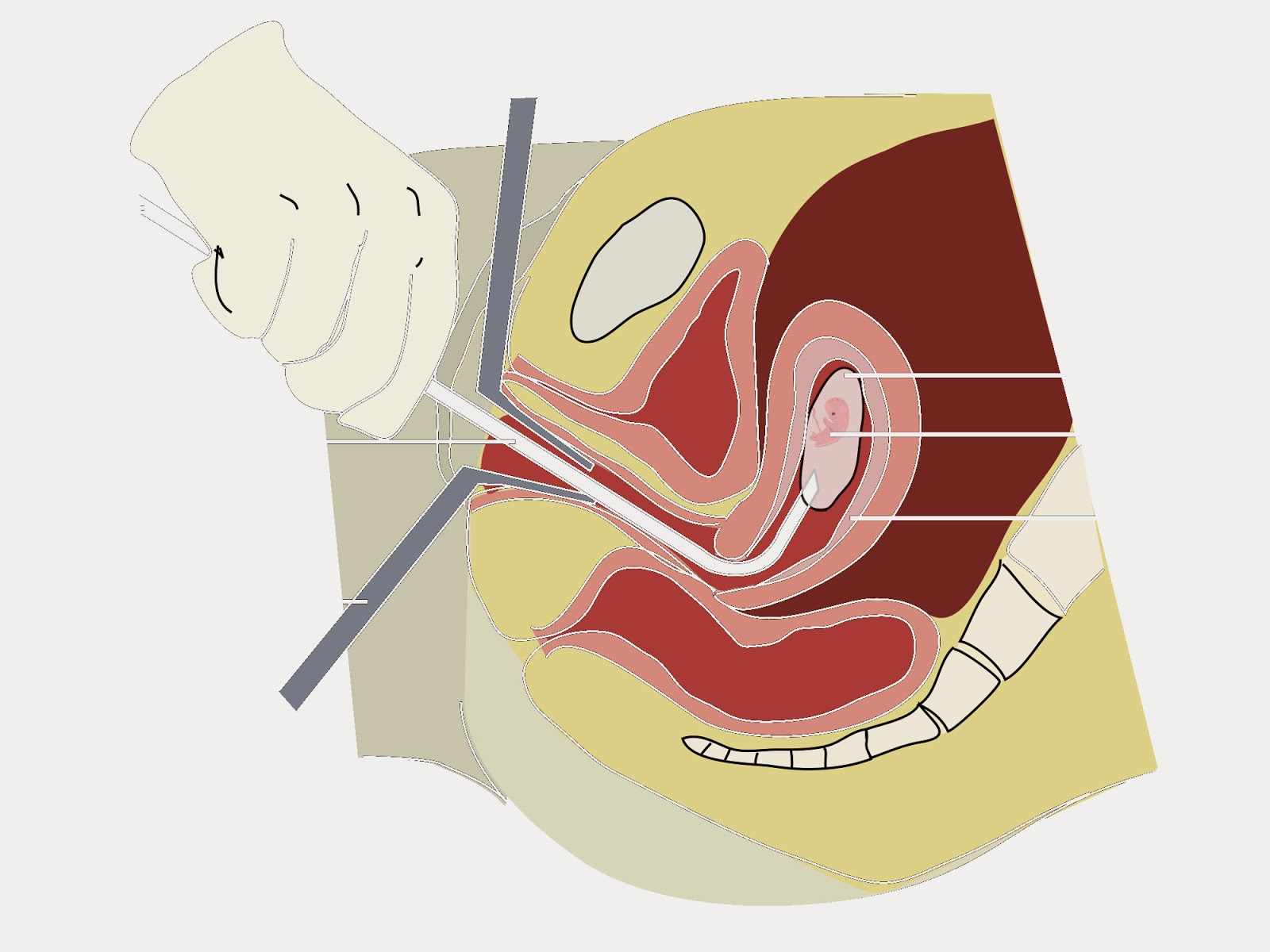 How do vacuum abortion (mini-abortion) - how dangerous this operation How do vacuum abortion (mini-abortion) - how dangerous this operation