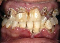 Piorrea o periodontitis se refiere a una etapa avanzada de la enfermedad periodontal en el que los ligamentos y huesos que soportan los dientes se inflaman y infectada .