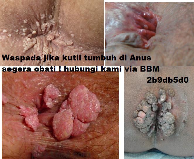 Ciri - Ciri Kondiloma Di Anus Ciri - Ciri Kondiloma Di Anus