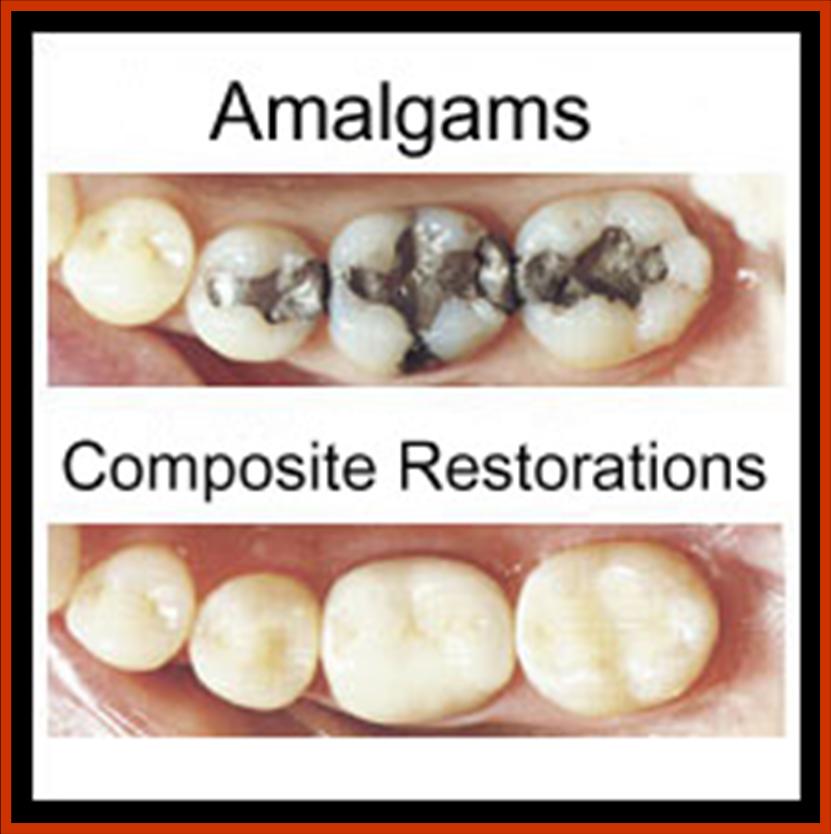 welcome lucy s to the truth truth about dentist mercury composite restoration