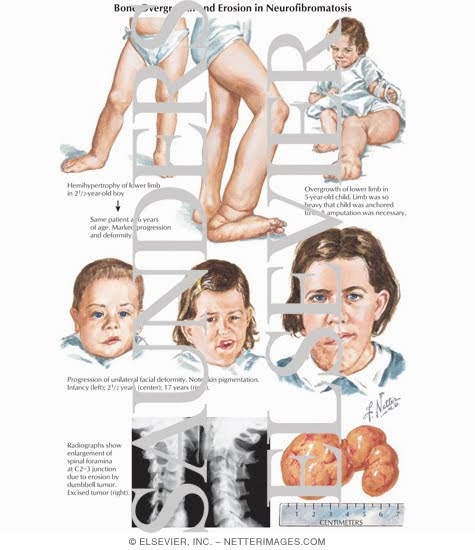 Free For Health: Neurofibromatosis