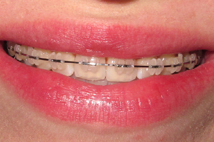 2 Months, 28 Days Malocclusion Class Ii. 2 Months, 28 Days