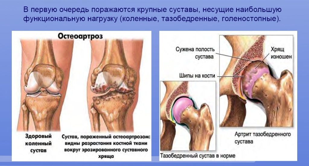 Реактивный артрит коленных суставов Реактивный артрит коленных суставов