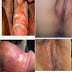 Obat Ampuh Atasi Sipilis Keparat thumbnail