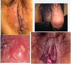SIPILIS obat sipilis manjur