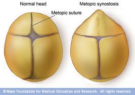 skull ridge craniosynostosis metopic suture quiz neurocranium quizlet houston sweet coronal