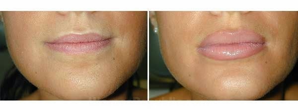 lip augmentation clinic lahore pakistan 2014