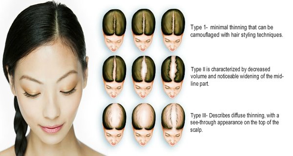 How To Stop Hair Loss Fast And Naturally Hair Loss