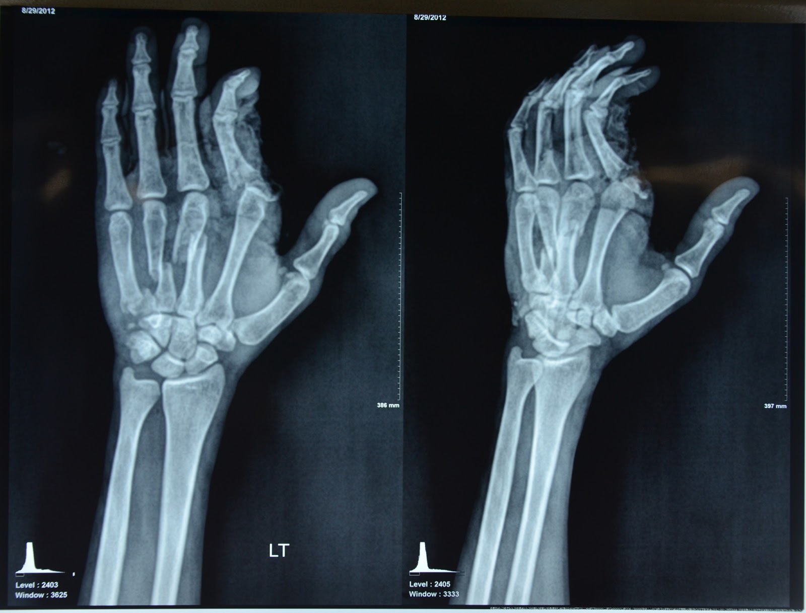 CRUSH INJURIES OF HAND AND UPPER LIMB INJURIES MAJOR CRUSH INJURY LEFT