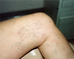 They can also develop on the legs, on the upper thigh, below the knee, and around the ankles.