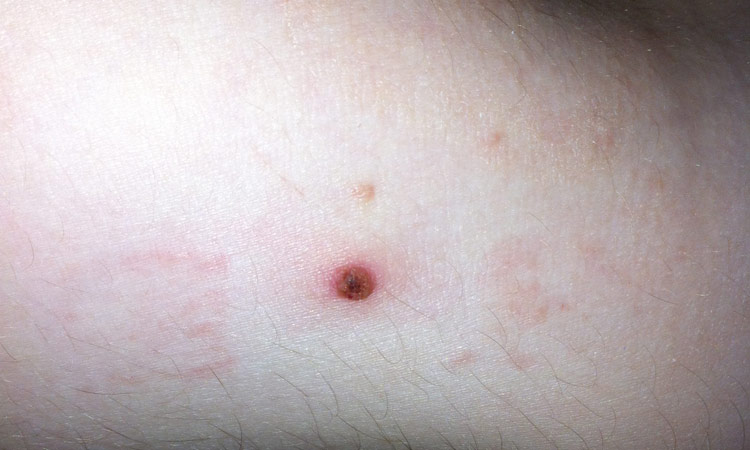 How to Remove a Mole with Apple Cider Vinegar April 2012