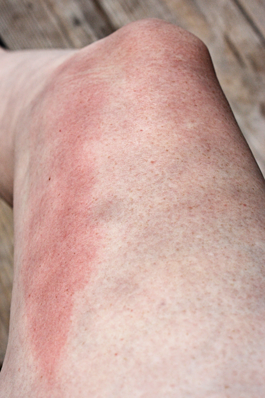 Seriously... Thoughts? Burn Baby Burn Part Two