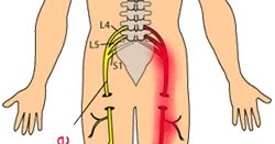 HEALTH FROM TRUSTED SOURCES: Sciatica