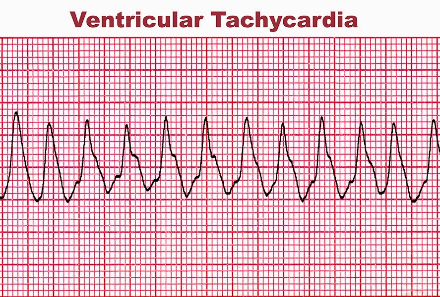 Stupid Heart Rhythms EKG Primer for Marketers Part II