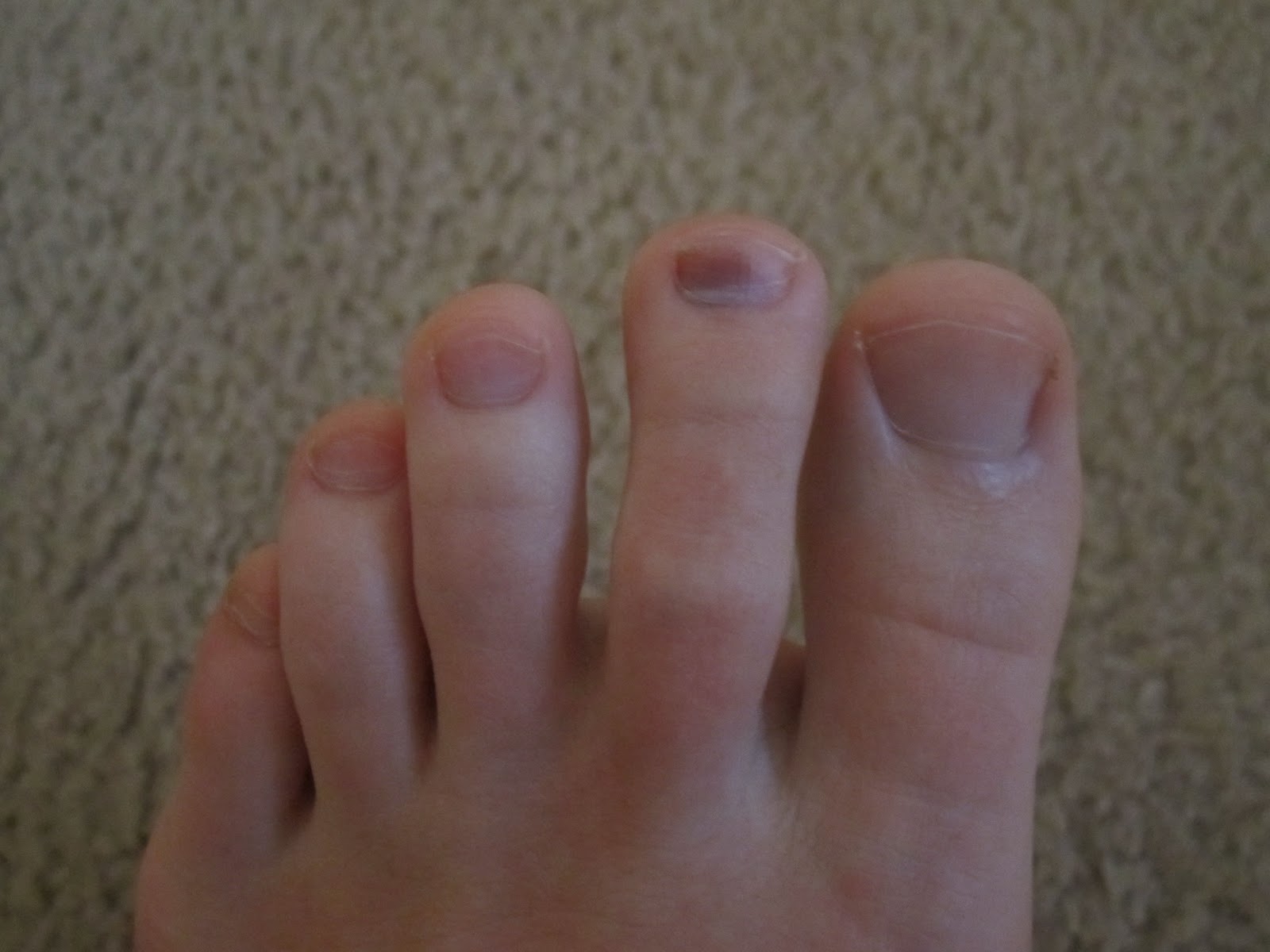 Black Toe
