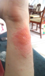 poison ivy rash wrist poison ivy rash wrist