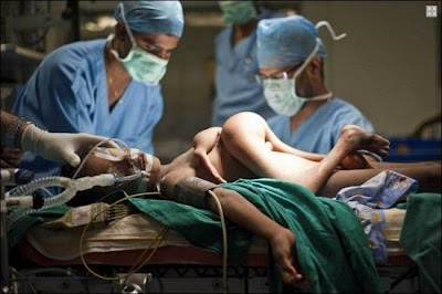 Indian Conjoined Twins pictures