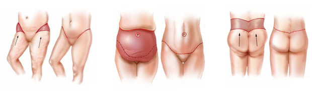 Lower body lift surgery affordable lower body lift abroad