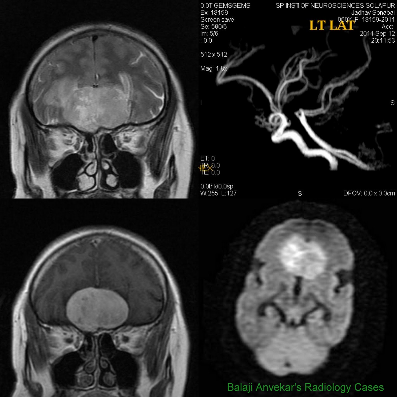 Dr Balaji Anvekar's Neuroradiology Cases Olfactory groove Meningioma MRI