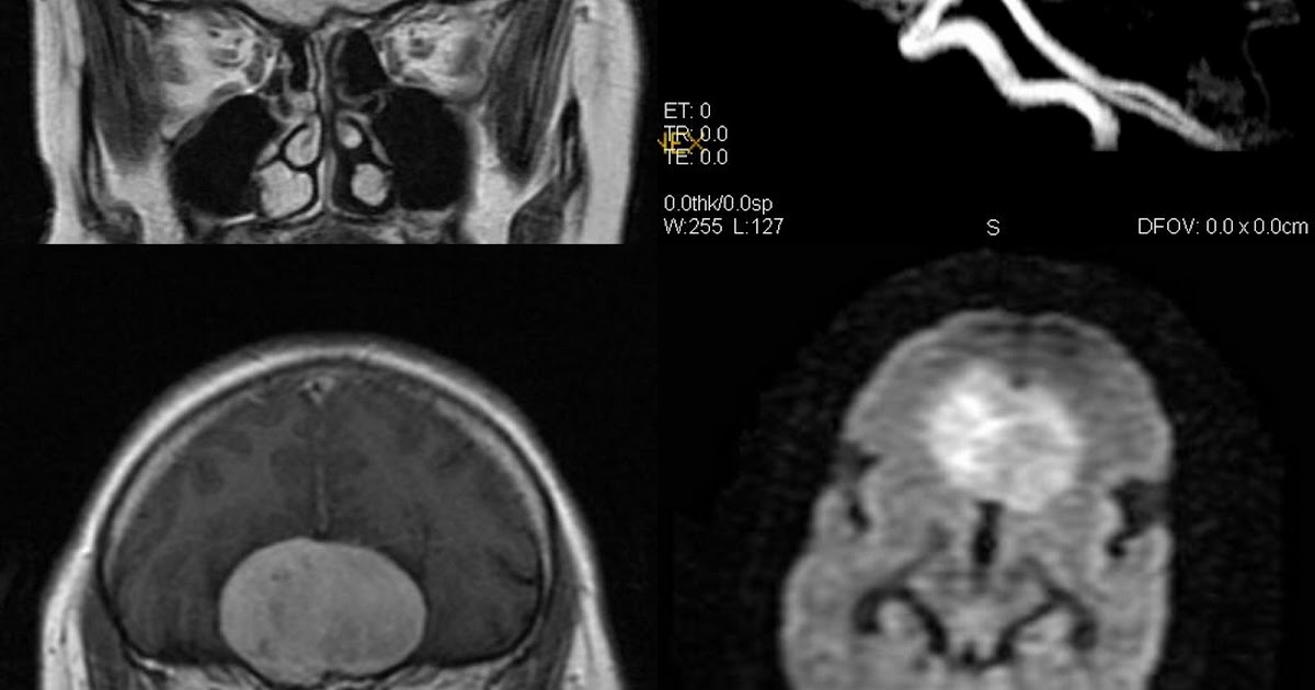 Neuroradiology Cases: Olfactory groove Meningioma MRI