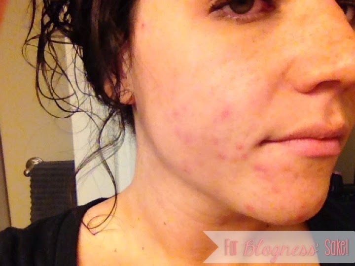 best makeup for adult acne best makeup for adult acne