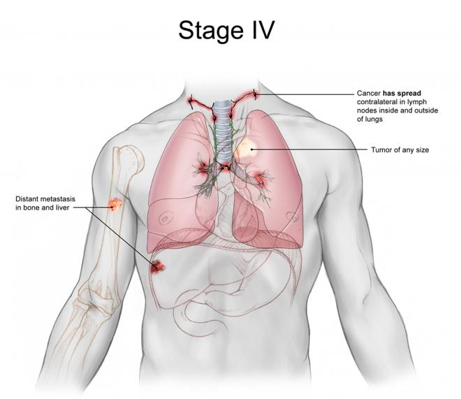 2019 year - Colon Cancer: What Do the Stages Mean 2019 year