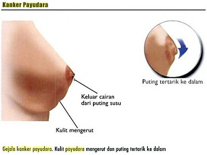 gejala-kanker-payudara